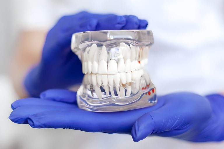 Teeth-In-A-Day Implants