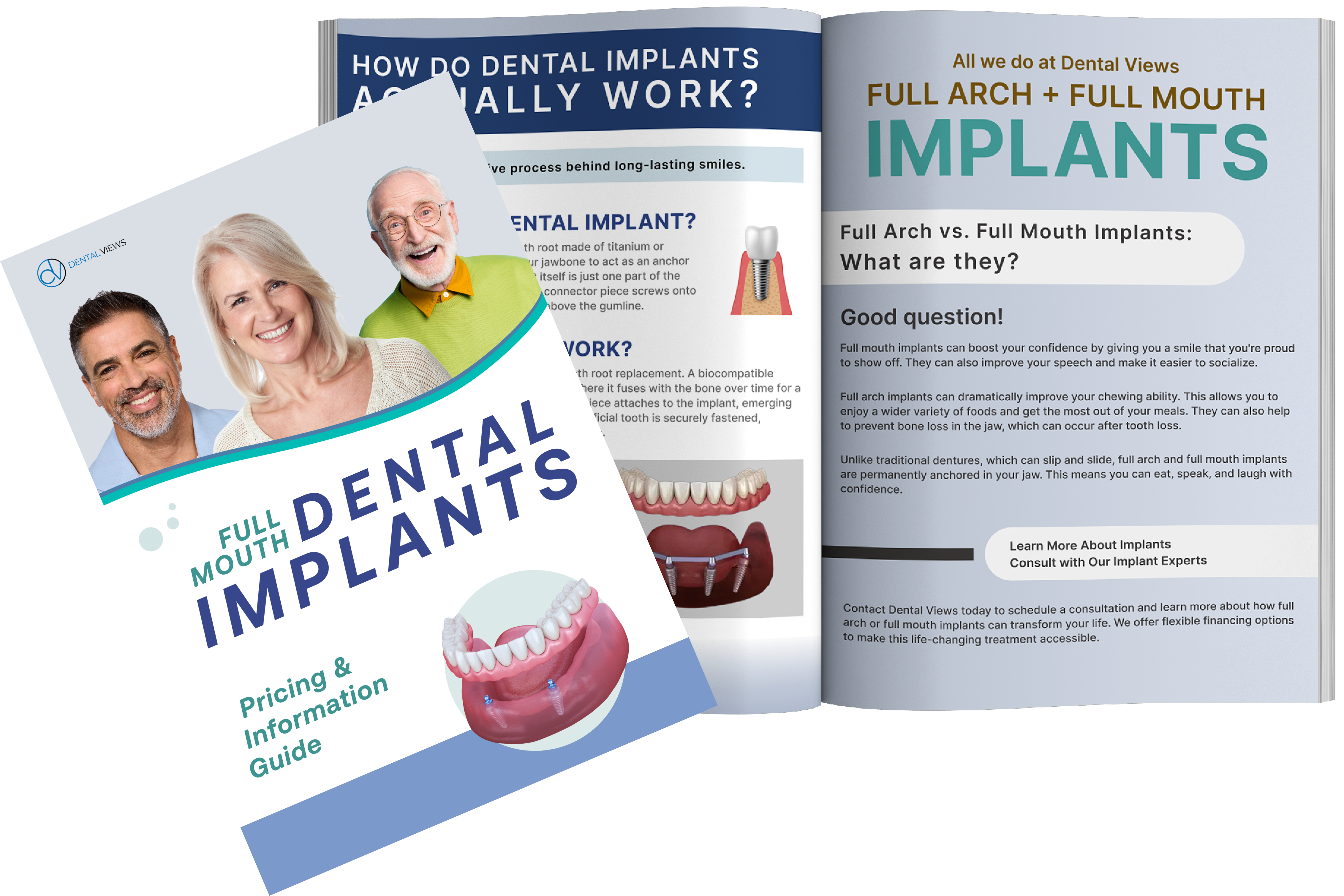 Dental Implant Pricing and Information Guide